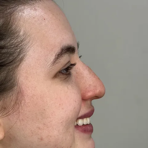 Paciente 2 — antes da rinoplastia