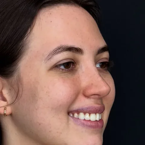 Paciente 2 — depois da rinoplastia