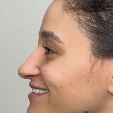 Paciente 3 — antes da rinoplastia